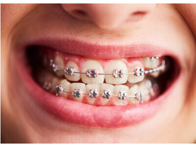 Get Dental Braces in Kenedy, TX � Agave 